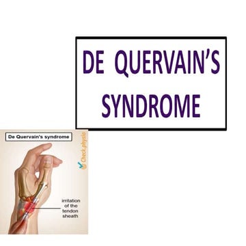 De quervain syndrome