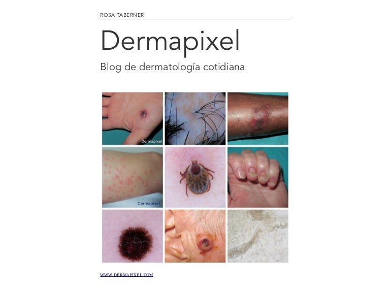 liquen plano folicular síntomas de diabetes