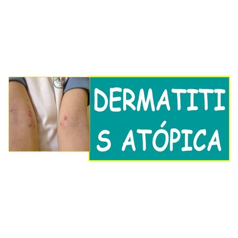 Dermatitis atopica pediatria | PPTX