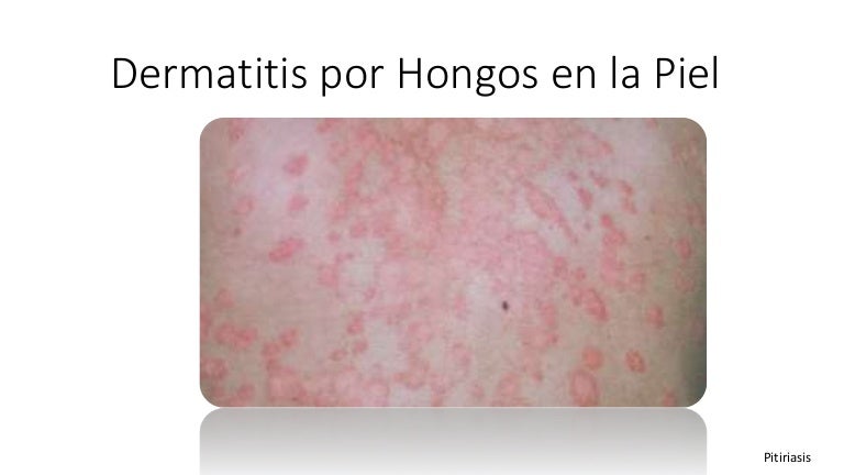 como sacar manchas de hongos en la piel