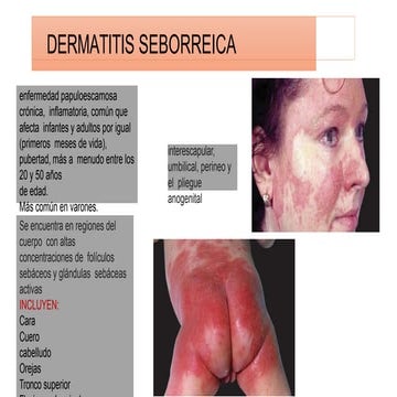 DERMATITIS SEBORREICA (1).pptx