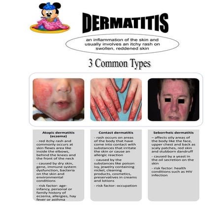 Atopic Dermatitis | PDF