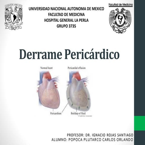 Derrame pericárdico