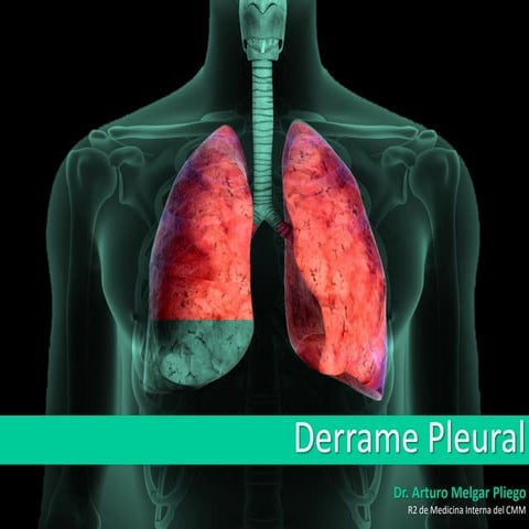 Derrame pleural