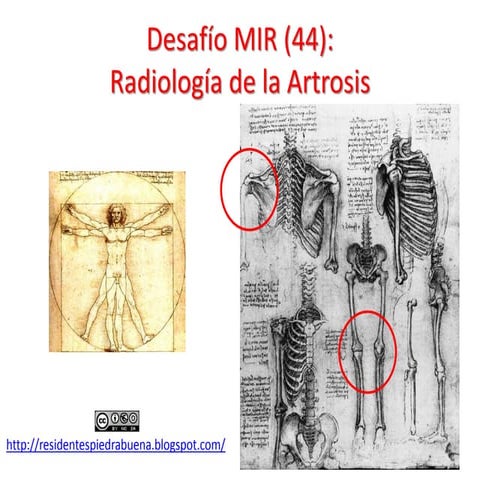 Desafío MIR (44) Artrosis