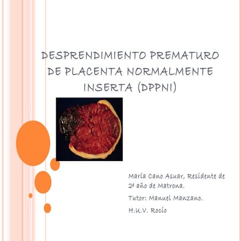 Desprendimiento prematuro de placenta normalmente inserta (dppni