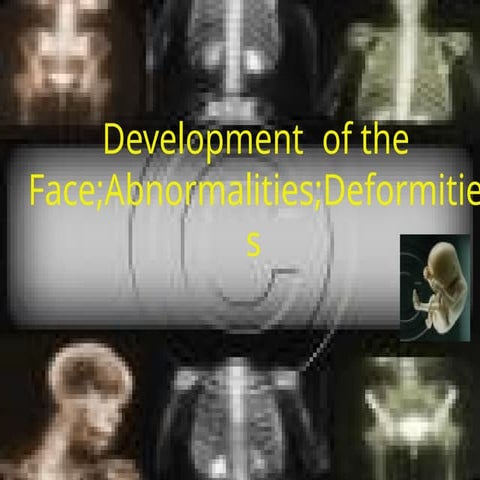 DEVELOPMENT of face n Craniofacial system AND ABNORMALITIES OF DEVELOPMENT OF...