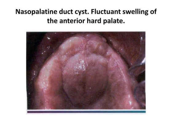 Nasopalatine duct cyst | PPT
