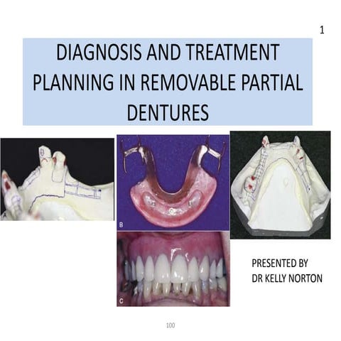 Diagnosis and treatment planning for removable partial dentures