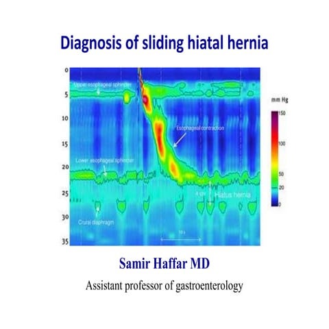 Diagnosis of sliding hiatal hernia