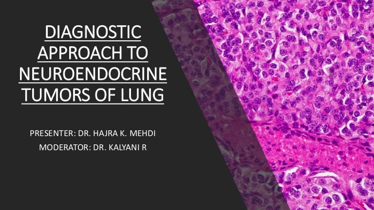 Neuroendocrine cancer lungs prognosis, Spitalul Sf. Constantin: Dr. Eugeniu Banu