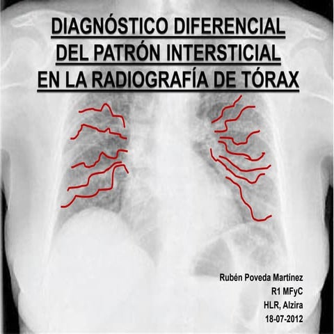 Patrones radiologicos en la enfermedad pulmonar intersticial | PDF
