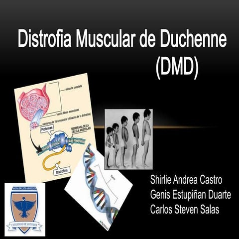 Distrofia Muscular de Duchenne | PPTX