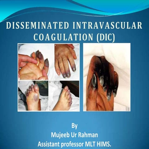 Disseminated intravascular coagulation | PPTX