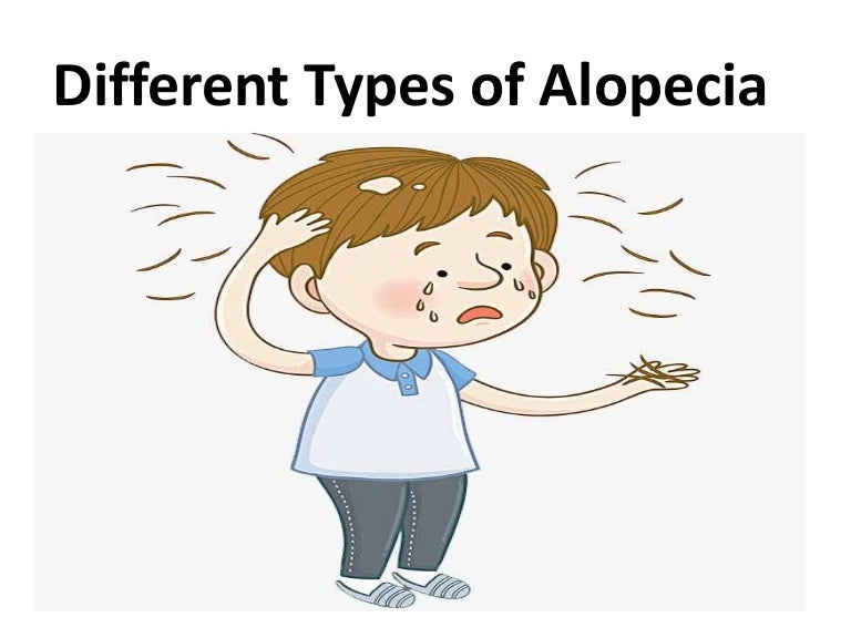 Different Types Of Alopecia
