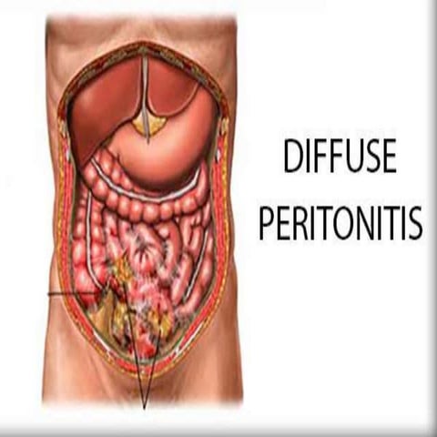 Diffuse peritonitis | PPTX