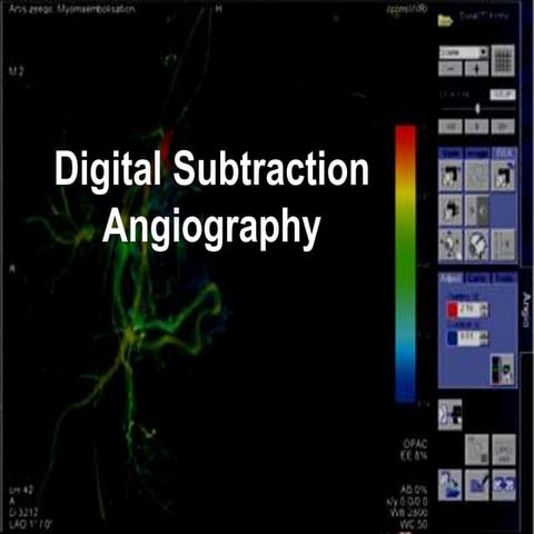 Digital subtraction angiography