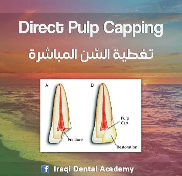 direct pulp capping an overview direct pulp capping