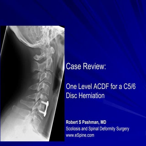 Case Review #1: 38 year old female with a single level cervical disc ...