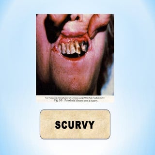 Health Problems Due to Bad Nutritio...