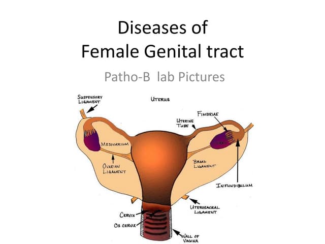Diseases of female genital tract | PPTX