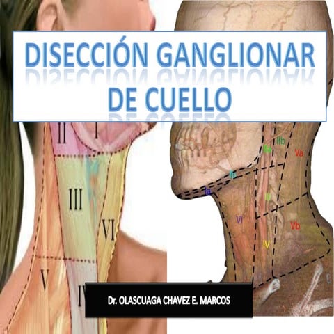 Disección ganglionar de cuello