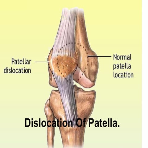 Dislocation of patella