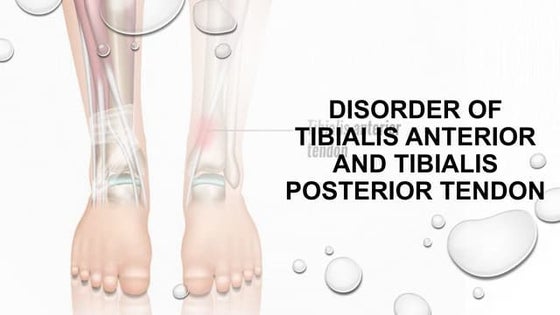 Tibialis Posterior Tendon Dysfunction | PDF