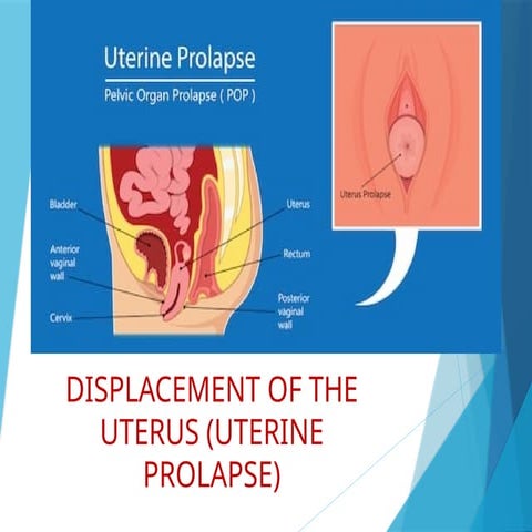 displacementofuterusa condition where the uterus moves from its normal positi...