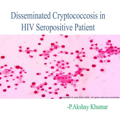 Disseminated cryptococcosis in HIV seropositive patient