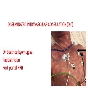 Disseminated intravascular coagulation ppt | PPTX