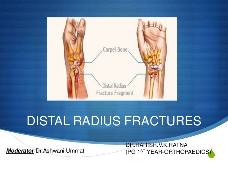 Distal end of radius fractures dr.harish