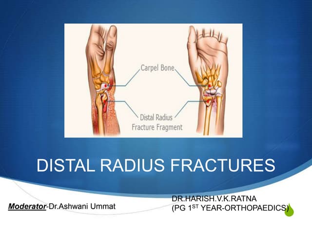Distal End Of Radius Fractures Dr Harish Distal End Of Radius Fractures Dr Harish