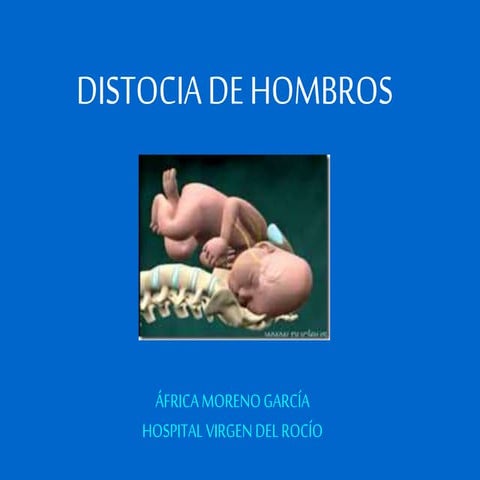 Distocia de hombros