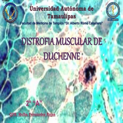 Distrofia muscular de duchenne | PPTX