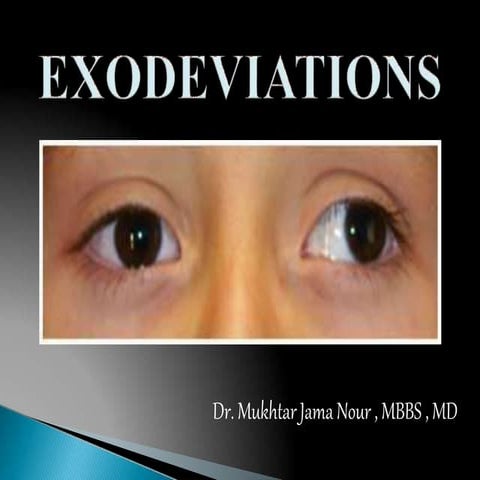 divergent squint.pptx