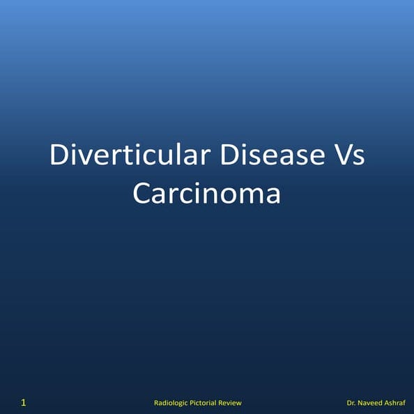 Diverticular disease v/s Carcinoma