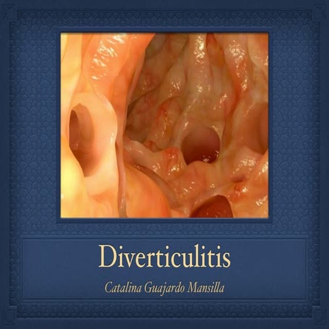 Diverticulitis 