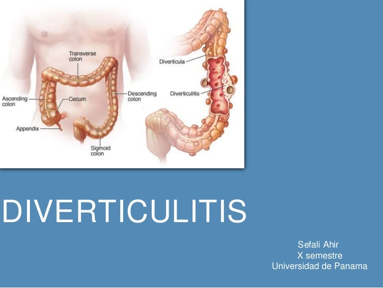 Diverticulitis