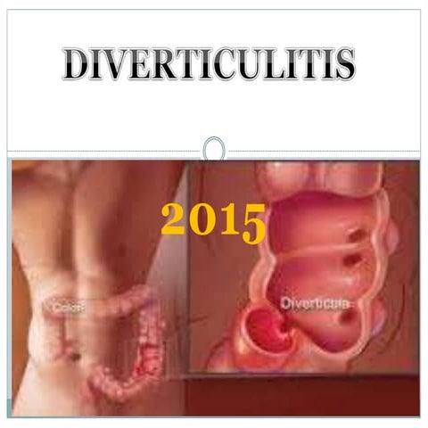 Diverticulitis 2015