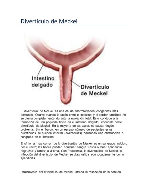 Diverticulo de meckel | PPT