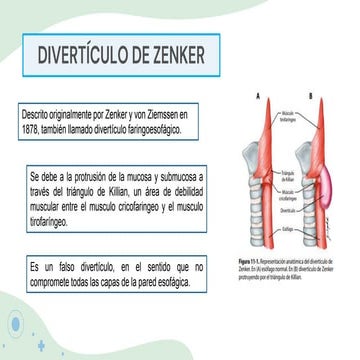 diverticulo-de-zenker-pptx