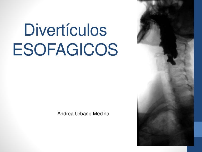 diverticulos esofagicos
