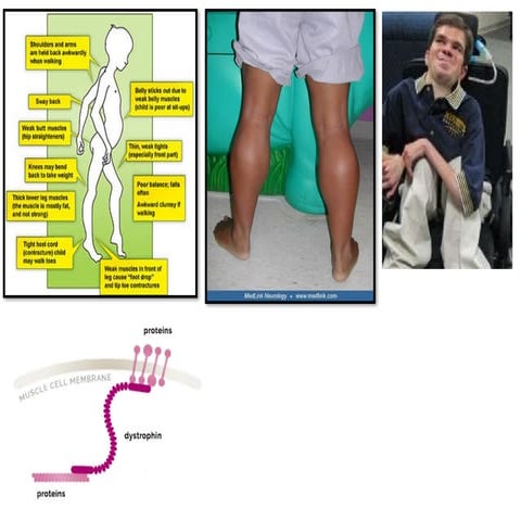 DUCHENNE MUSCULAR DYSTROPHY PRESENTATION | PPTX