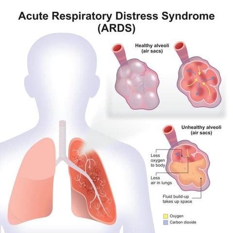 ACUTE RESPIRATORY DISTRESS SYNDROME ( ARDS ) | PDF