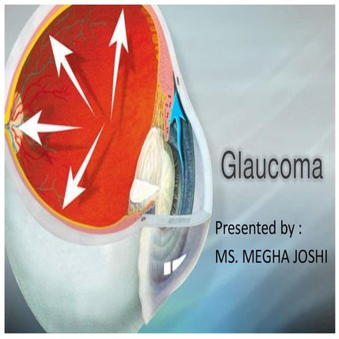 Power point presentation on Glaucoma (B. Sc nursing) | PDF