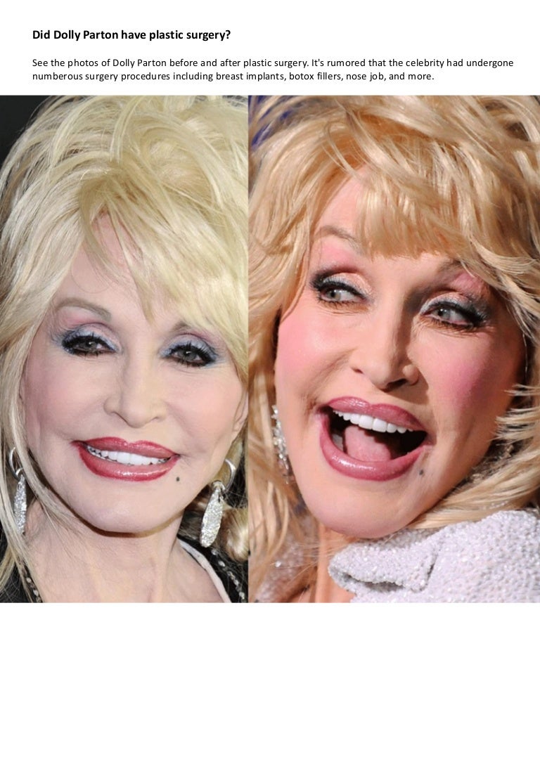 Dolly Parton Plastic Surgery Pictures Before & After