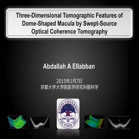 Dome shaped macula  in High myopia - Swept-source Optical coherence tomograph...