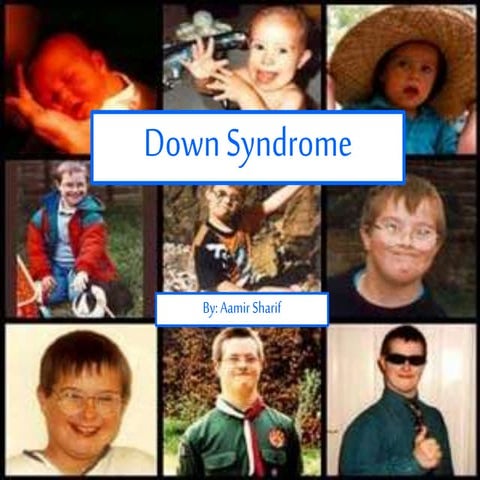 Down syndrome | PPTX
