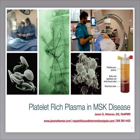 Platelet rich plasma | PPTX